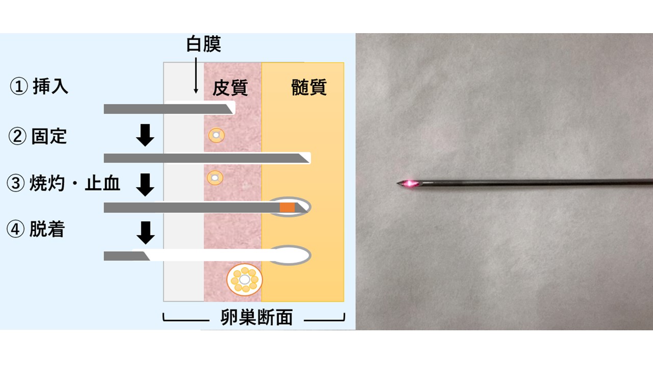 穿刺刺激によるウシ卵胞の活性化　穿刺劇の行程（右），レーザーを装着した穿刺針（左）