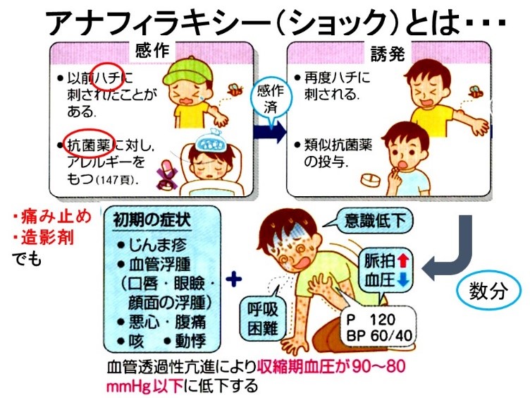 【図1】アナフィラキシーの病態 （宮城大学「疾病論II」風間教授の授業資料より）